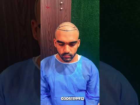 Hair Transplant Procedure in Lahore | Hairline Planning to Implantation