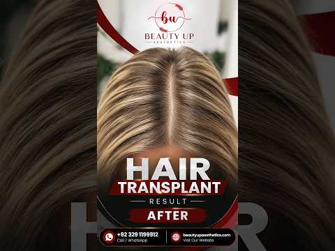 Hair Transplant Before & After Result | Real Patient Transformation | Beauty Up Aesthetics Lahore