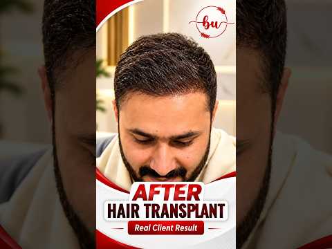 Real Hair Transplant Before & After Results | Beauty Up Aesthetics Lahore