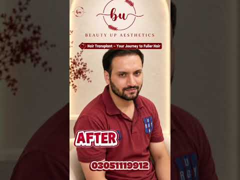 From Thinning Hair to Fuller Hair | Hair Transplant Results