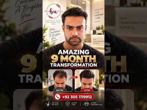9 Months Hair Transplant Results in Lahore | Beauty Up Aesthetics #Shorts