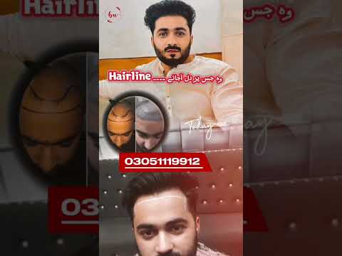 Real Hair Transplant Transformation | Before & After Results | Hair Restoration Lahore