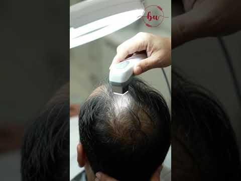 Considering a Hair Transplant? Start with an Assessment | Dr. Mufassar Nishat Rana