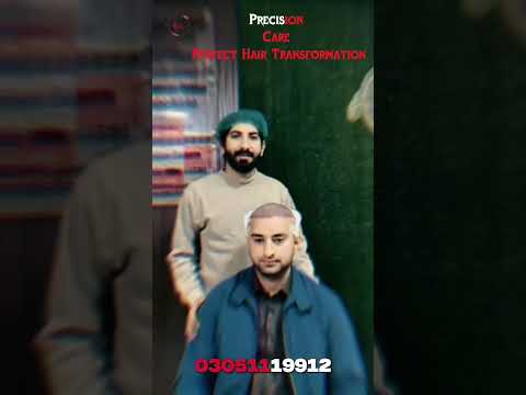 Hair Transplant Before & After Results | Natural Hair Restoration | Beauty Up Aesthetics
