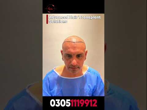 Hair Transplant Procedure & Hairline Design | Hair Transplant in Pakistan