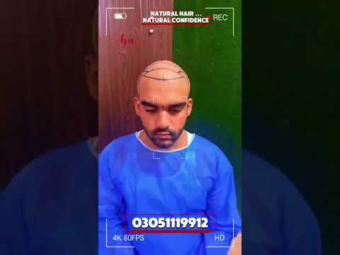 Hair Loss Solution in Lahore | Natural Hair Transplant & PRP Treatment | Beauty Up Aesthetics