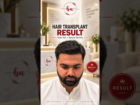 Hair Transplant Result in Lahore | Before & After Hair Restoration | Beauty Up Aesthetics